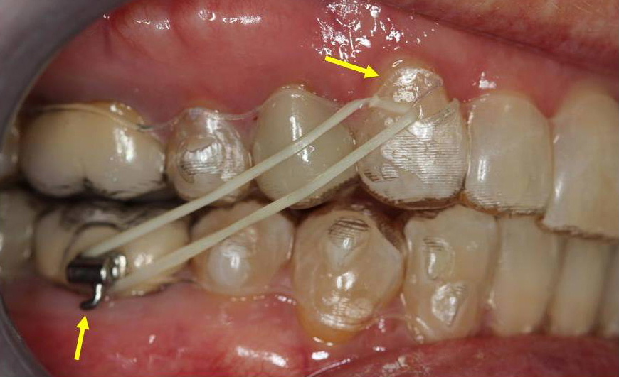 Class II elastics with Invisalign