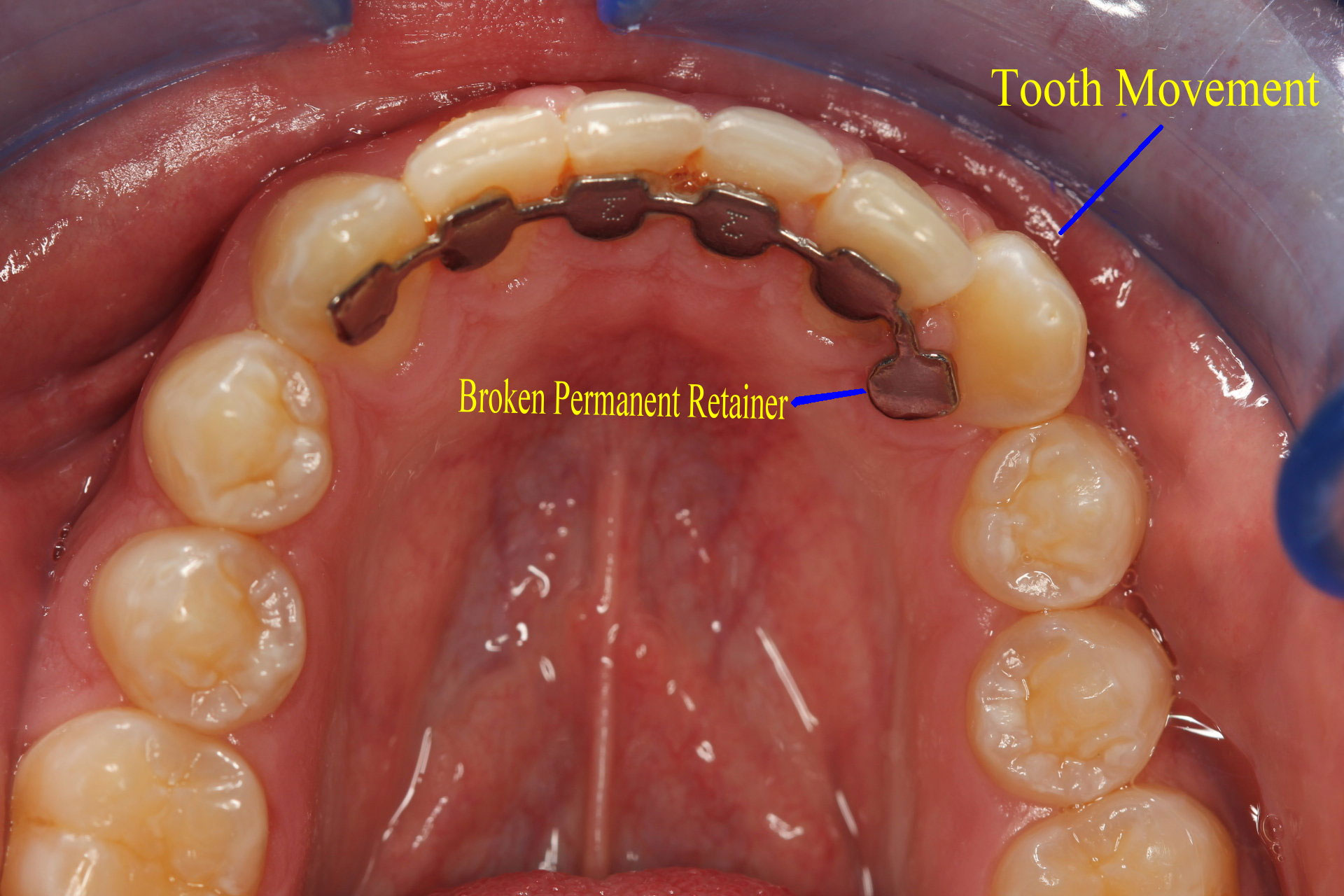 Broken Permanent Retainer