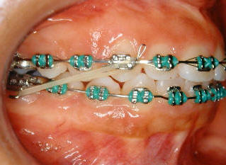 Class II Elastics