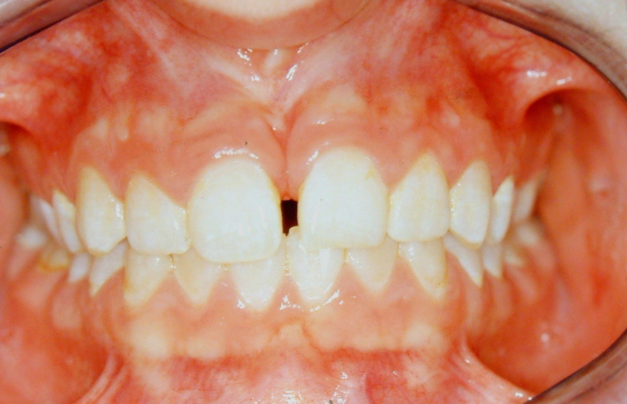 Limited Orthodontic Treatment Gallery