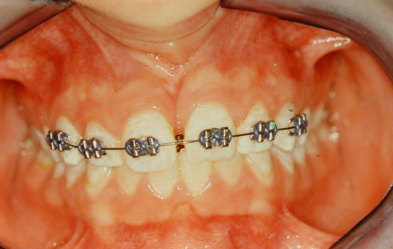 Limited Orthodontic Treatment Gallery