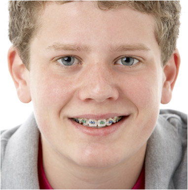 Traditional Braces