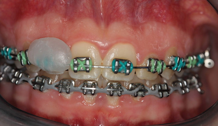 Wax On Brackets