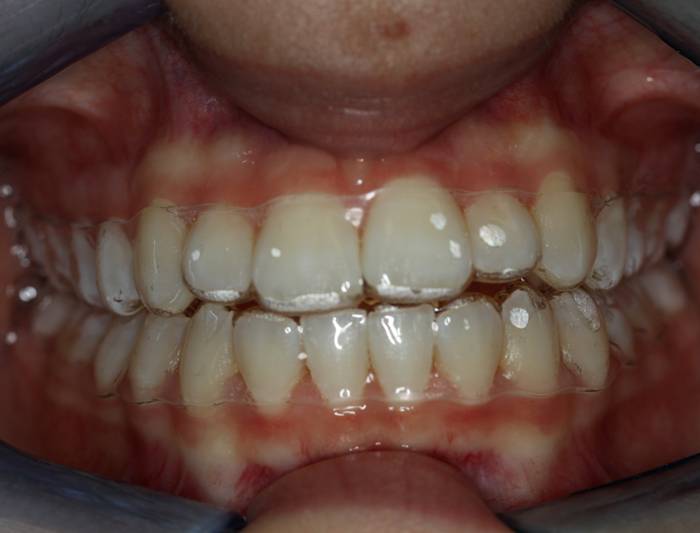 Clear Aligner