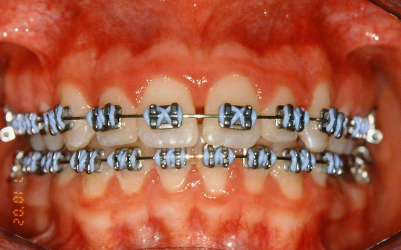 Stainlees Steel Braces